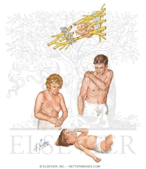 Brachial Plexopathy