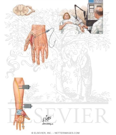 Watermarked preview of unlabeled image: Electrodiagnostic Studies In Compression Neuropathy