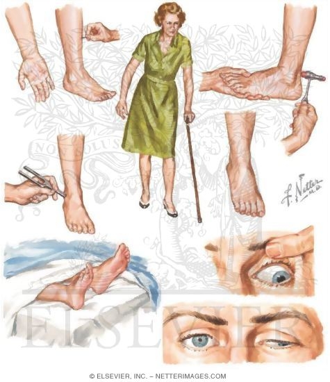 Watermarked preview of unlabeled image: Peripheral Neuropathies: Clinical Manifestations