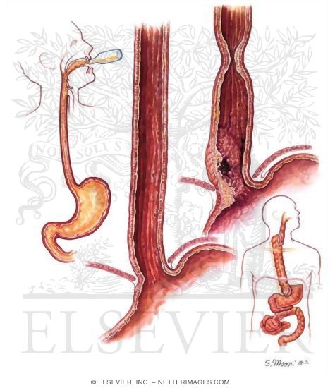 Caustic Injury of the Esophagus