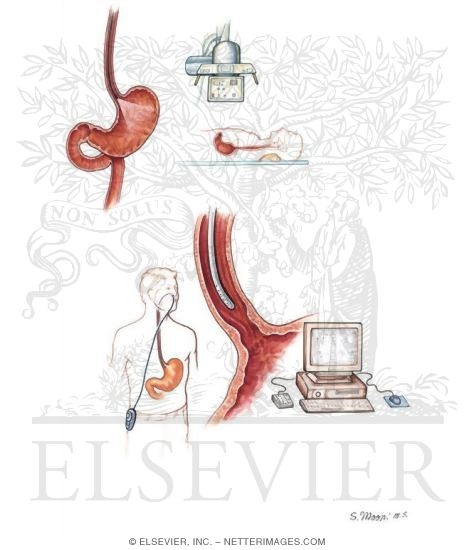 Watermarked preview of unlabeled image: Esophageal Tests for Gastroesophageal Reflux Disease (GERD)