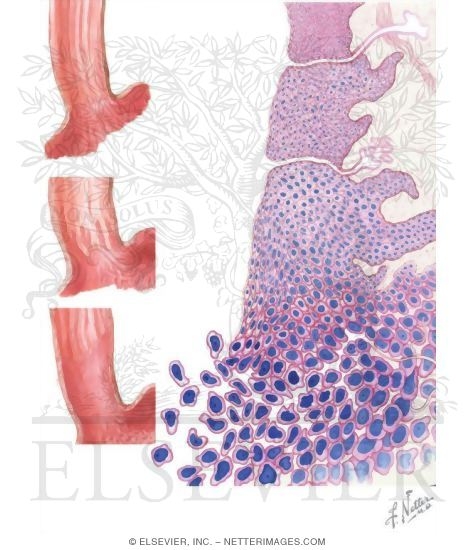 Watermarked preview of unlabeled image: Barrett Esophagus