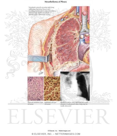 Captivating C45.0 Mesothelioma Of Pleura Photo Collection