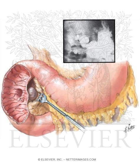 Diverticula of the Duodenum
