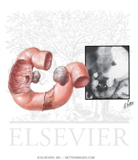 Watermarked preview of unlabeled image: Diverticula of the Duodenum