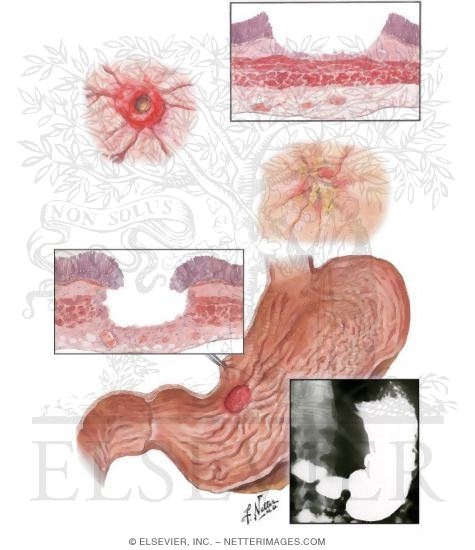 Illustration of Subacute and Chronic Gastric Ulcers from the Netter Collection