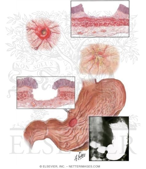 Subacute and Chronic Gastric Ulcers