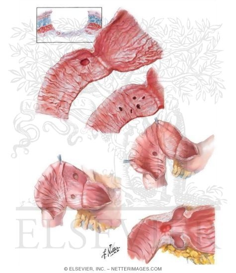Watermarked preview of unlabeled image: Duodenitis and Duodenal Ulcers