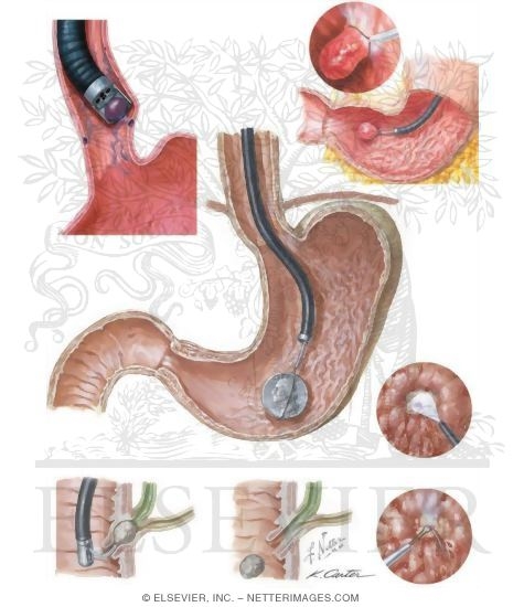 Therapeutic Endoscopy