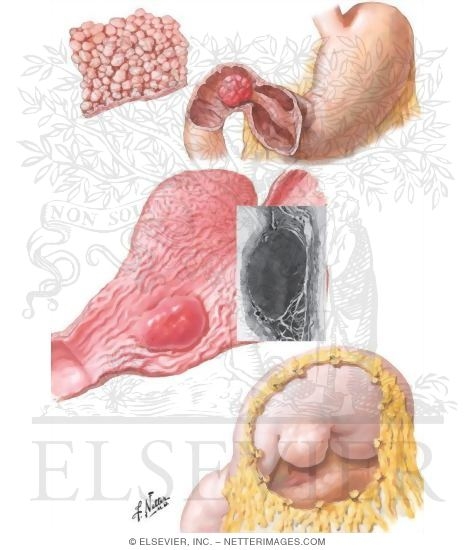 Benign Gastric Tumors