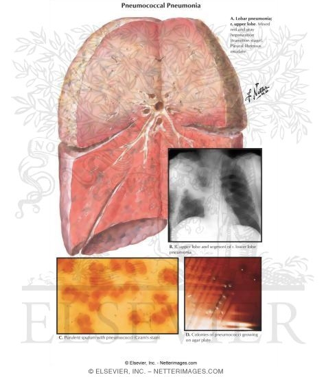 Watermarked preview of labeled image: Pneumococcal Pneumonia