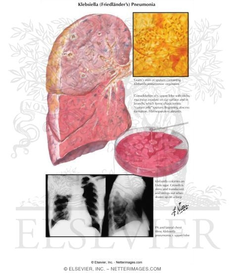 Klebsiella (Friedlander's) Pneumonia
