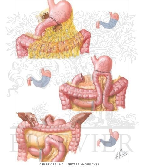 Watermarked preview of unlabeled image: Principles of Gastric Surgery