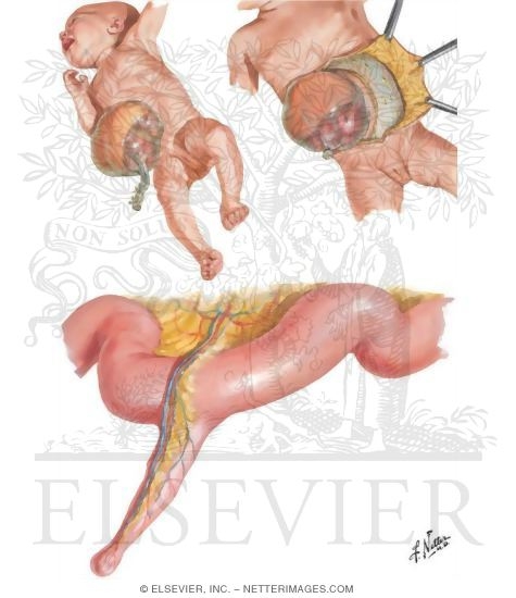 Abdominal Wall and Cavity: Congenital Abnormalities