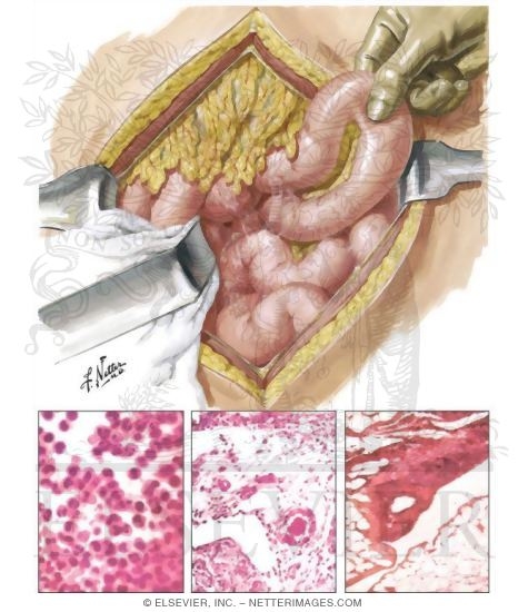 Watermarked preview of unlabeled image: Benign Paroxysmal Peritonitis Or Familial Mediterranean Fever