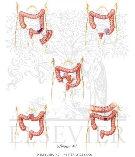 Watermarked preview of unlabeled image: Abdominal Wounds of the Colon
