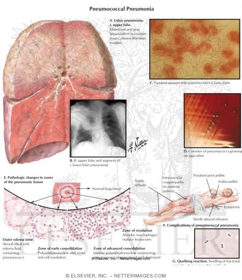 Pneumococcal Pneumonia