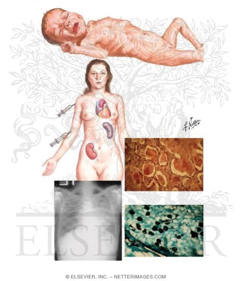 Pneumocystis Carinii Pneumonia