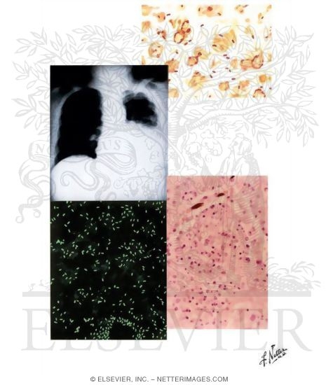 Watermarked preview of unlabeled image: Legionnaires' Disease