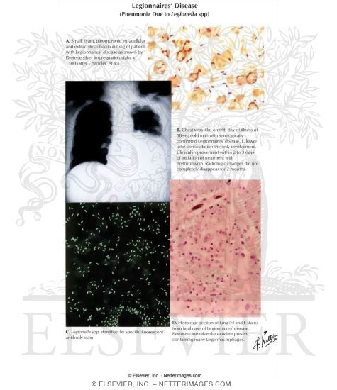 Watermarked preview of labeled image: Legionnaires' Disease