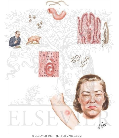 Watermarked preview of unlabeled image: Trichinosis