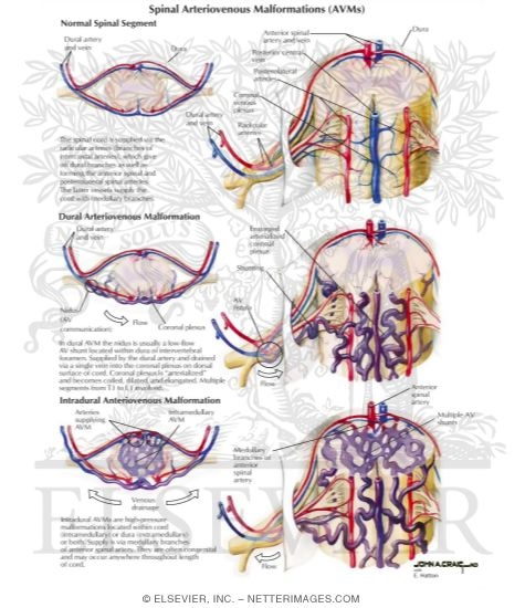 Watermarked preview of labeled image: Spinal Arteriovenous Malformations (AVMs)