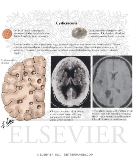 Watermarked preview of labeled image: Cysticercosis