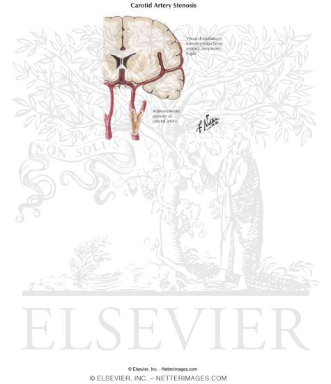 Watermarked preview of labeled image: Carotid Artery Stenosis