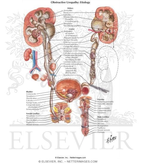 Obstructive Uropathy: Etiology