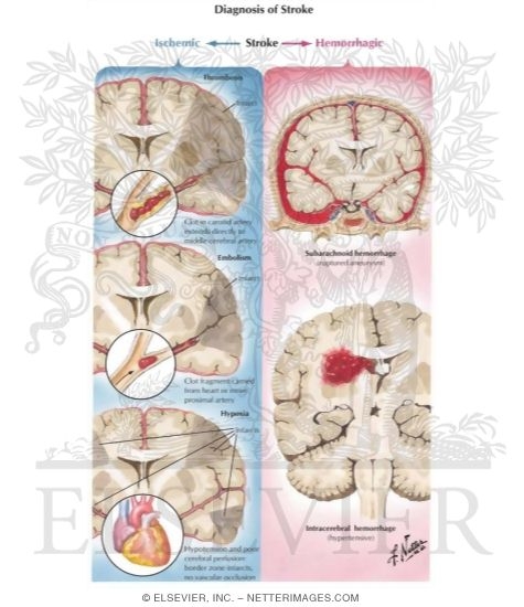 Watermarked preview of labeled image: Diagnosis of Stroke