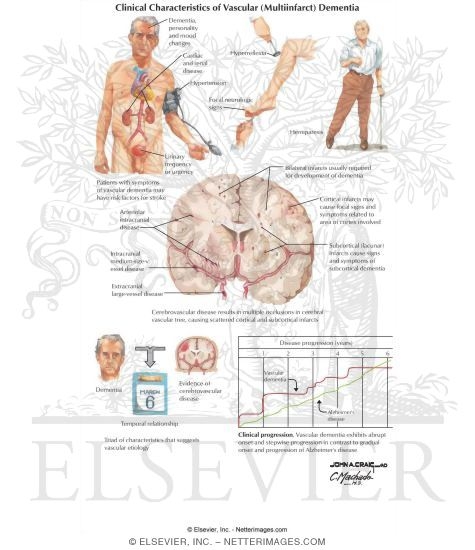 Clinical Characteristics of Vascular (Multiinfarct) Dementia