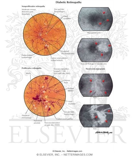 Diabetic Retinopathy