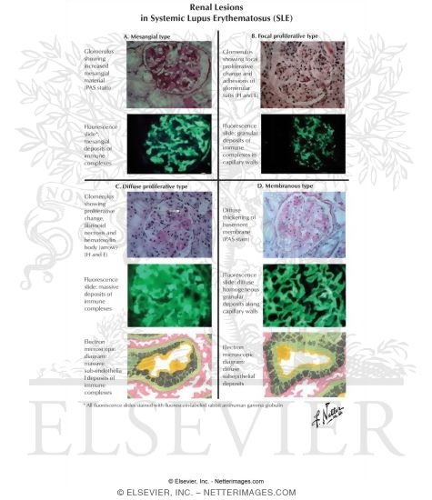 Watermarked preview of labeled image: Renal Lesions in Systemic Lupus Erythematosus (SLE)