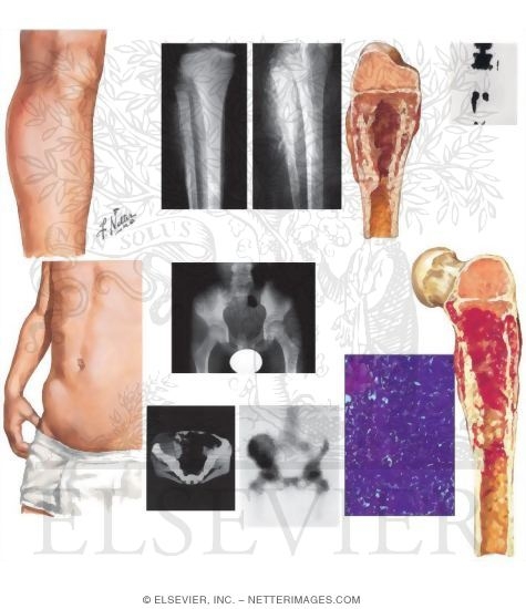 Ewing's Sarcoma
