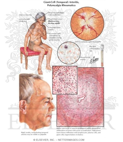 Giant-Cell (Temporal) Arteritis, Polymyalgia Rheumatica