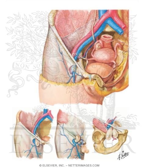 Femoral Hernias