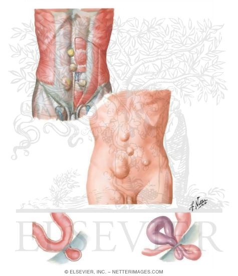Abdominal Wall: Ventral Hernias
