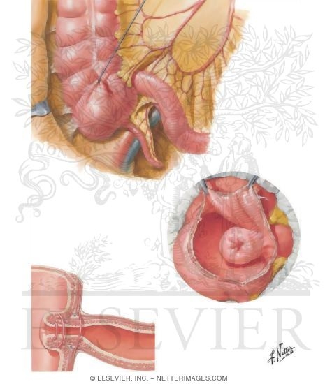 Watermarked preview of unlabeled image: Ileocecal Region
