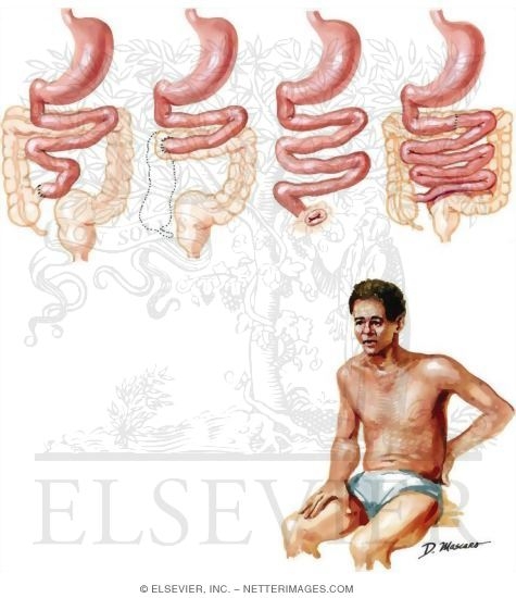 Watermarked preview of unlabeled image: Short Bowel Syndrome