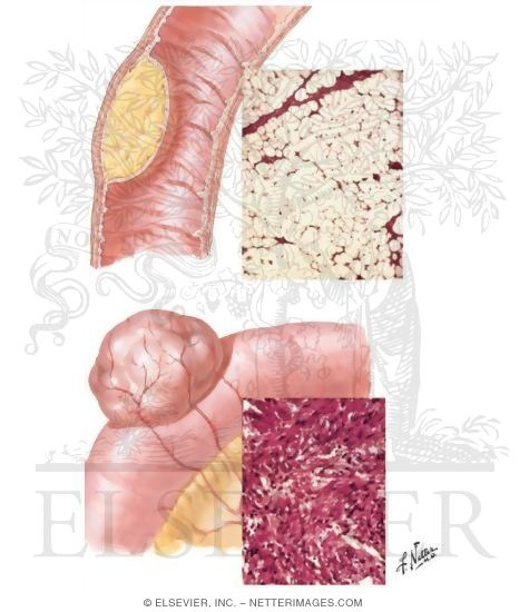 Watermarked preview of unlabeled image: Benign Tumors
