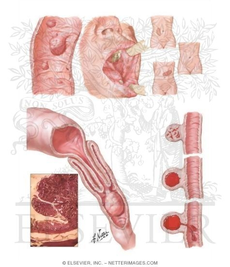 Peutz-Jeghers Syndrome - Complications of Benign Tumors