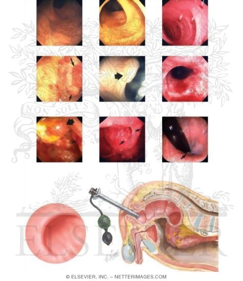 Anoscopy, Sigmoidoscopy, and Colonoscopy