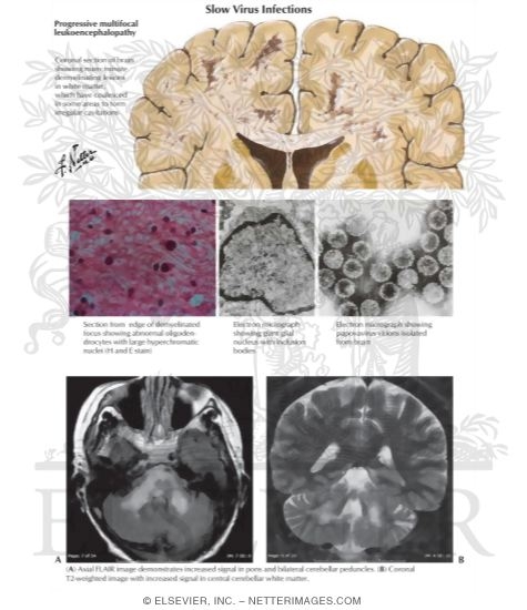 Slow Virus Infections