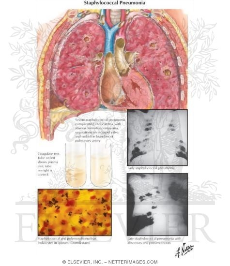 Staphylococcal Pneumonia