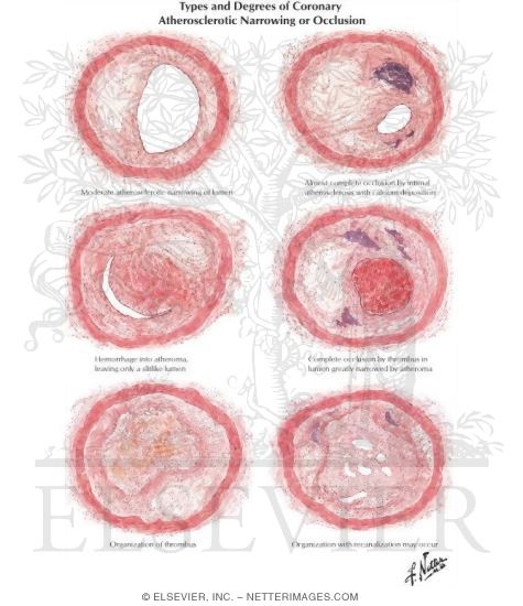 Pathologic Changes In Coronary Artery Disease Types And Degrees Of