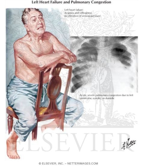 Watermarked preview of unlabeled image: Left Heart Failure and Pulmonary Congestion