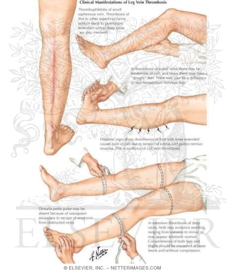 Watermarked preview of unlabeled image: Clinical Manifestation of Leg Vein Thrombosis