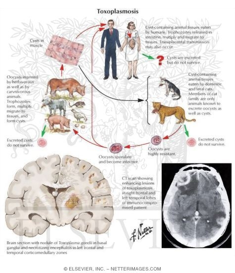 Watermarked preview of unlabeled image: Toxoplasmosis