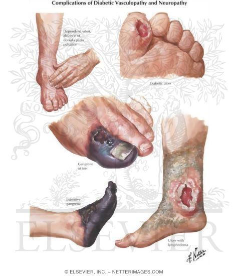 Watermarked preview of unlabeled image: Vascular Insufficiency In Diabetes
Complications of Diabetic Vasculopathy and Neuropathy