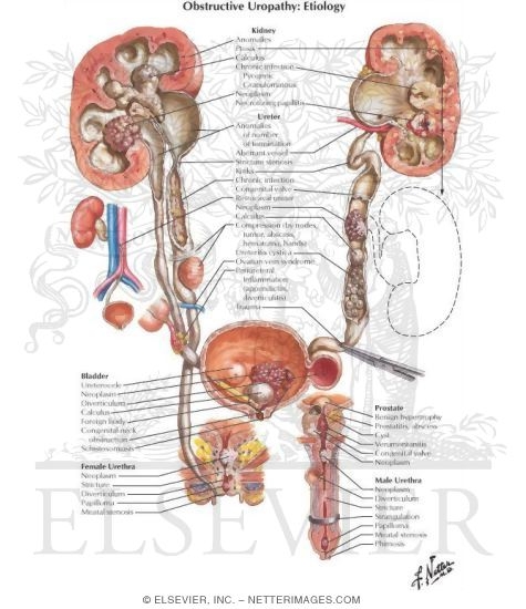 Obstructive Uropathy: Etiology